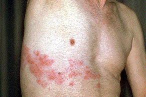 Picture of Shingles rash