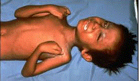 child with Tetany